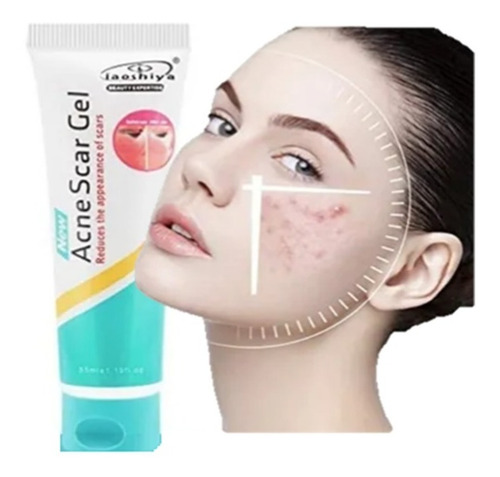 Imagen 1 de 5 de Crema Gel Contra Acne,espinillas,repara, Inflamacion Facial