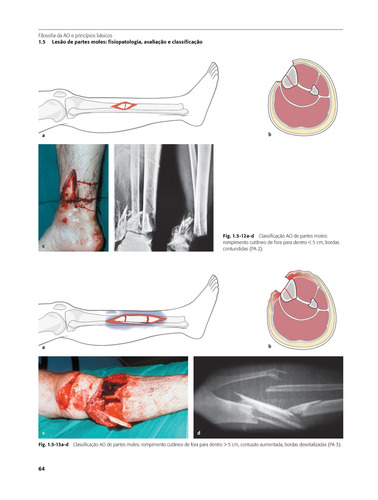 Princípios AO do Tratamento de Fraturas - 2 Volumes, de Buckley, Richard E.. Editorial ARTMED EDITORA LTDA.,Thieme Medical Publishers Inc., New York, capa dura em português, 2020