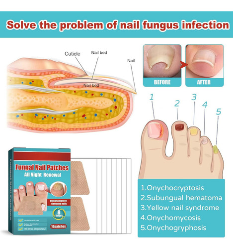 16 Parches De Uñas Para Hongos Tratamiento Onicomicosis