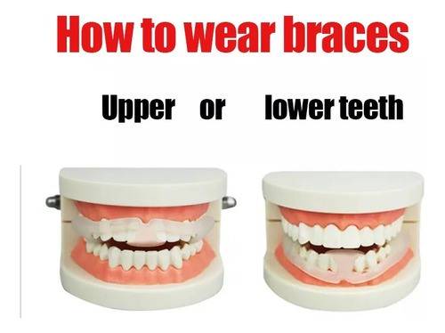 6pzs Antimolar Protector Bucal For Rechinar Dientes Dormir