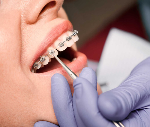 Brackets Ortodoncia Roth Mini. (caso) 0.022 Slot Hook 3-4-5