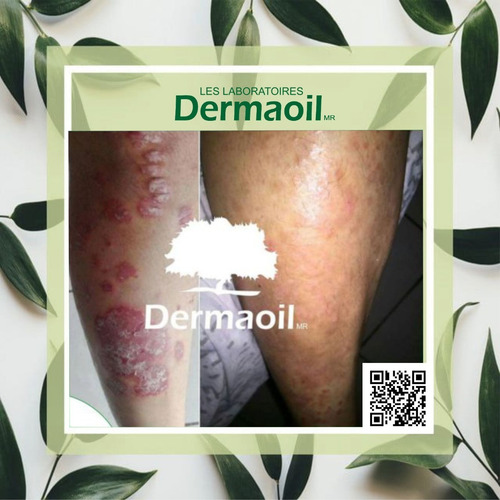 Imagen 6 de 7 de Jabón De Argán Y Caléndula Natural Para Psoriasis