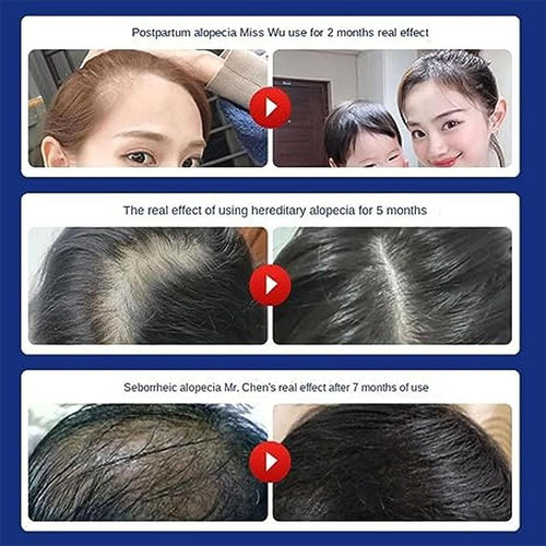 Xinnuo Shampoo Antiqueda De Cabelo E Crescimento Capilar 240
