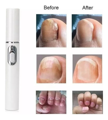 Lápiz Láser Para Hongos En Uñas, 2 Bolígrafos, Luz Azul