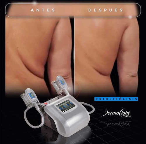 Imagen 2 de 3 de Criolipolisis , Elimina Adiposidad Localizada.