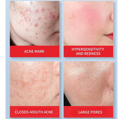 Xx Crema Retráctil Crema Salicílica 30 Ml Acid Pore