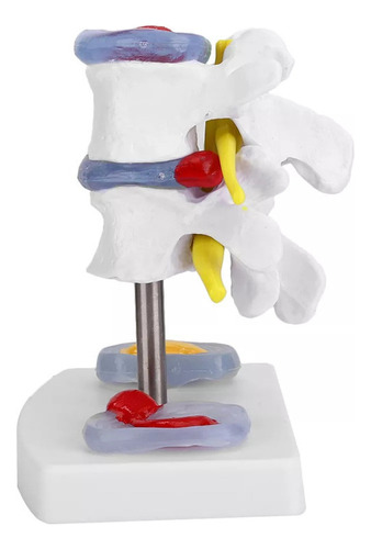 Modelo De Demostración De Hernia Discal Lumbar Anatómica
