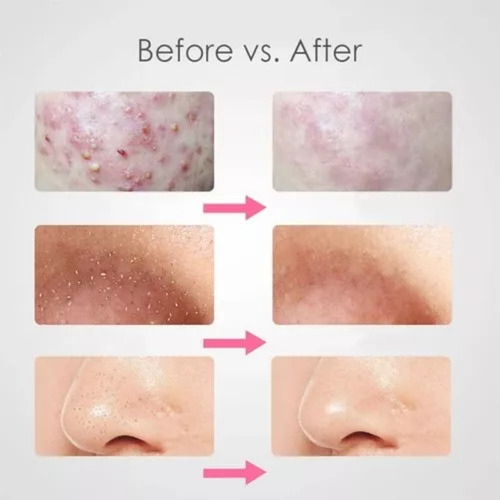 Limpiador Ultrasonico Masaje Facial Digital Peeling Lifting