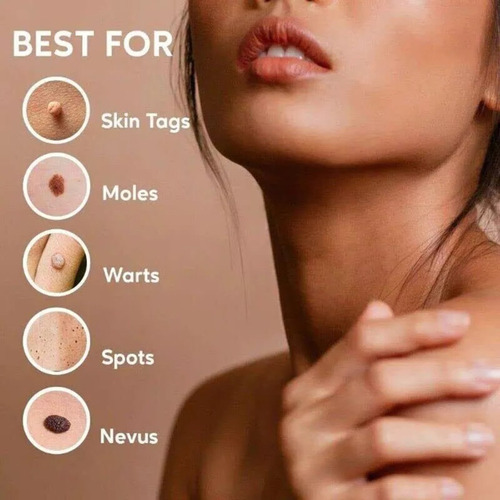 A Crema De Removedor Corporal Eliminador De Verrugas *4.