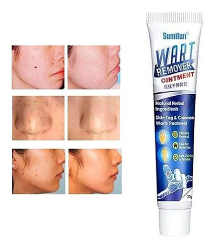 Removedor De Verrugas, Vph, 2 Unidades
