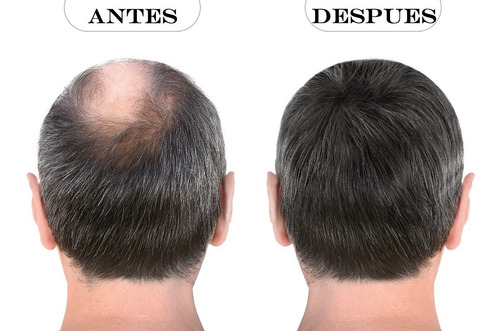 Kit Loción Capilar Noxidil + Roller Cabello The Shaving Co.