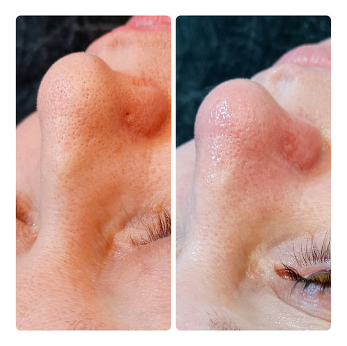 Limpieza Facial Profunda En Sáenz Peña, 3 De Febrero
