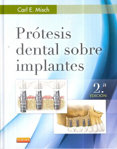 Libro Prótesis Dental Sobre Implantes De Carl E. Misch