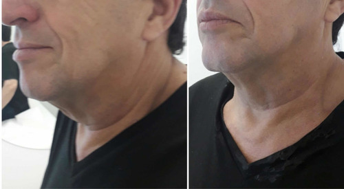 Imagen 1 de 4 de Hifu 7d Ultrasonido Focalizado - Lifting Sin Cirugía