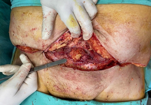 Imagen 3 de 5 de Vac Alquiler Heridas Terapia Pie Diabetico