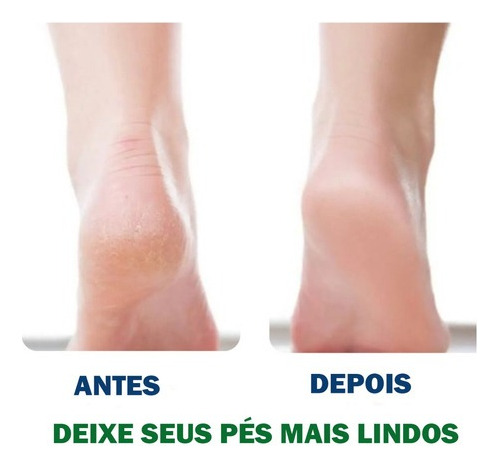 Aparelho Para Lixar Os Pés Removedor De Calos Rachaduras