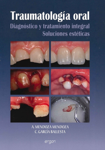 Traumatología Dental - Mendoza A. - Ergon