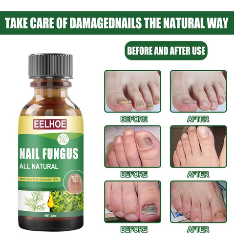Esmalte De Uñas 3toe: Solución Para El Cuidado De Hongos-