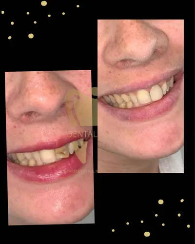 Carilla Dental En Resina (precio Por Unidad)