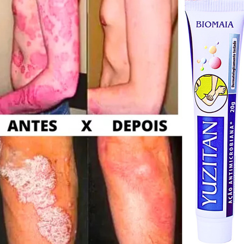 Creme Psoríase Dermatite Alergia Coceira Com Vermelhidão
