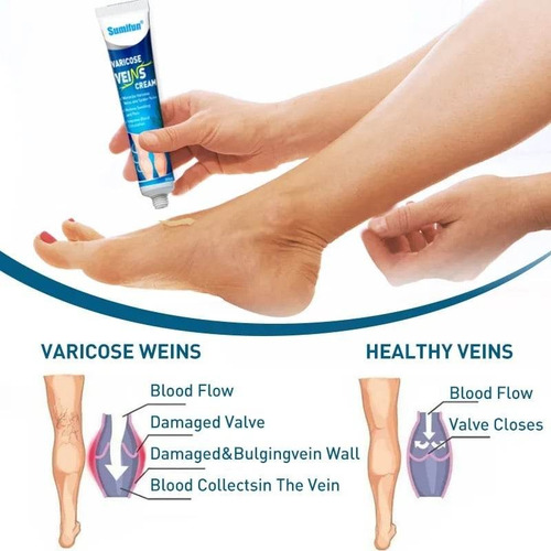 Crema Quita Varices Super Efectiva Desinflama Alivia Hierbas