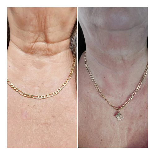Microcorriente Sonic + Gel Anti-age+ A.h 20ml+ 24 H