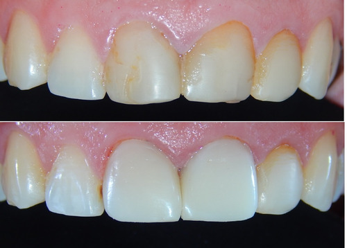 Carillas Dentales De Composite (no Se Envian A Domicilio) 