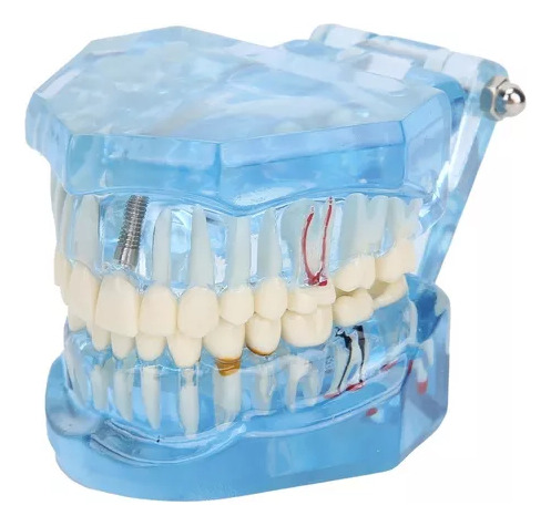 Dos Modelos Dentales De Enfermedad De Los Implantes Dentales