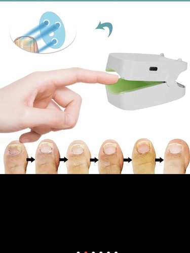 Láser Eliminación Para Hongos Uñas (onicomicosis)