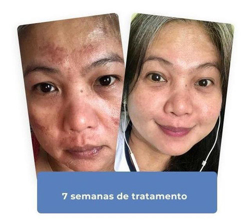 Nano Clareador Serum Facial Para Melasma E Manchas De Sol
