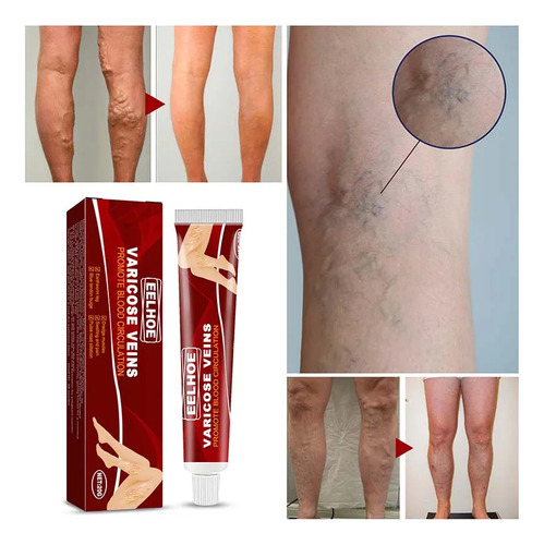 Crema para Venas Varicosas Trata Varices Hinchazón Dolores en las Piernas Fragancia Suave Tipo de Embalaje Tubo