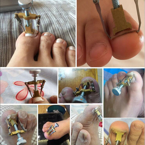 Corrector Profesional De Uñas Encarnadas De Acero Inoxidable