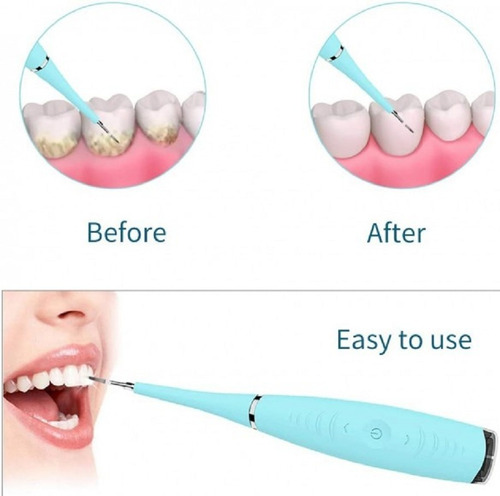 Removedor Dental Ultrasonico Portátil Usb Cálculos