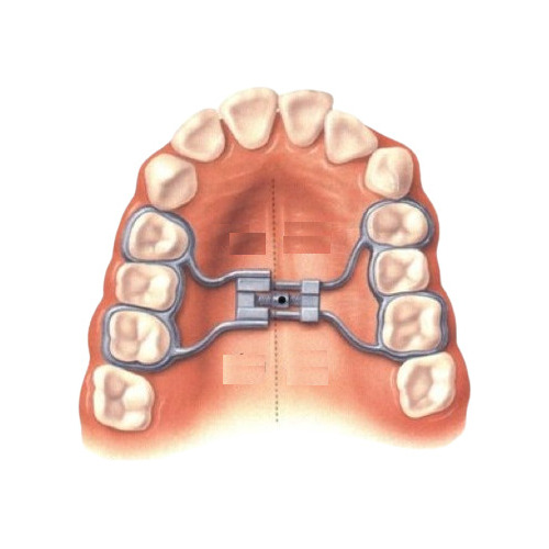 Expansor Hyrax Laboratorio Dental