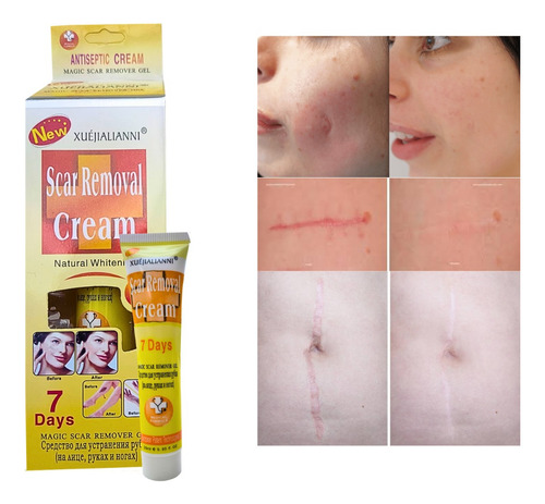 Crema Removedora  De Cicatrices  En 7 Dias /scar Removal