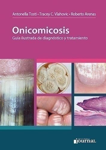 Onicomicosis - Tosti, Antonella (papel)