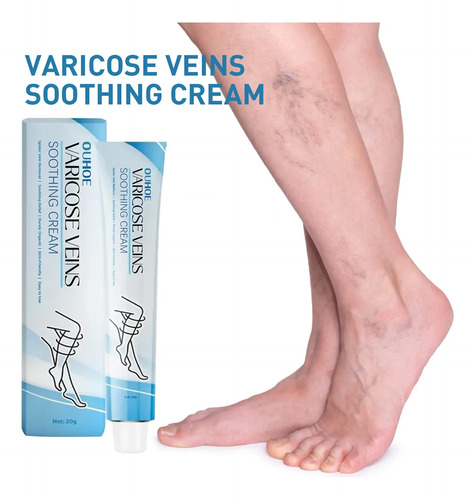 Crema Para Aliviar La Vasculitis, Flebitis, Lombriz, Patas D