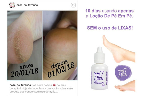 Locao De Pe Em Pe Trata Protege Rápido Confirme