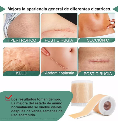 Hojas De Parche Silicona Para Cicatriz Reutilizable 4*300cm
