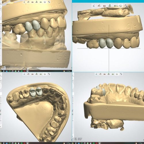 Corona Dental De Porcelana Tecnología Cad Cam