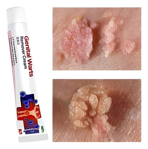 1x Pomada Tira Verruga Hpv Coceiras Manchas Fungos Neutra