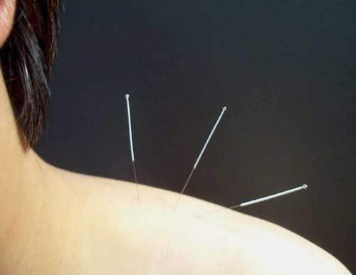 Imagem 1 de 5 de Acupuntura E Massagem Em Domicílio, Mande Mensagem No Whats.