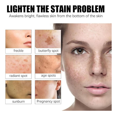 Crema De Urea Para Atenuar Manchas, Crema Coreana Para Elimi