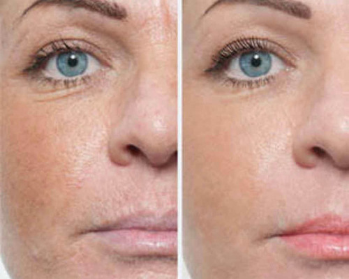 Imagem 4 de 4 de Limpeza De Pele Com Dermaplaing