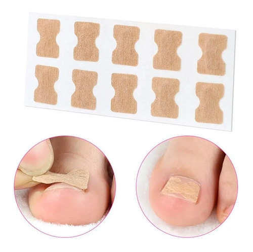 5 Blister Con 10 Parche C/u De Corrección De Uñas Encarnadas