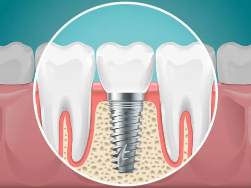 Implantes Dentales