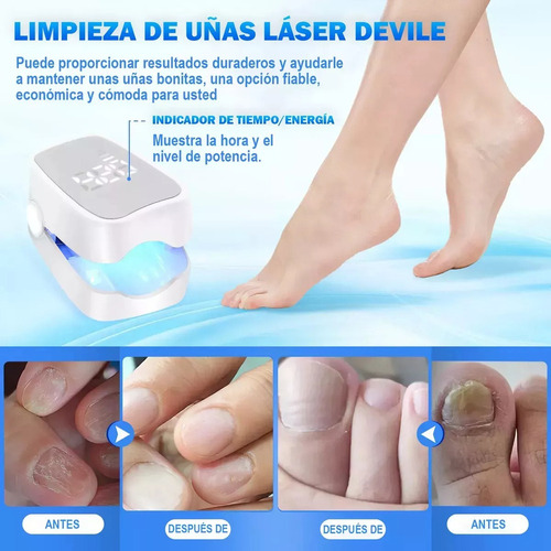 . 2 Pzs Tratamiento Láser De Hongos En Las Uñas Y