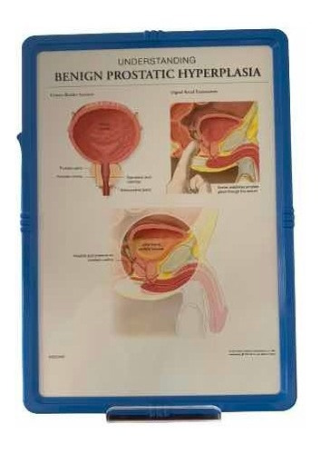 Lámina Anatómica Hiperplasia Prostática Benigna