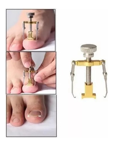 Grampo Corretor Unha Encravada Ferramenta Pedicure Dourado