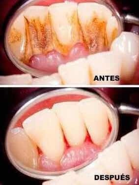 Limpieza Dental (limpieza De Sarro)